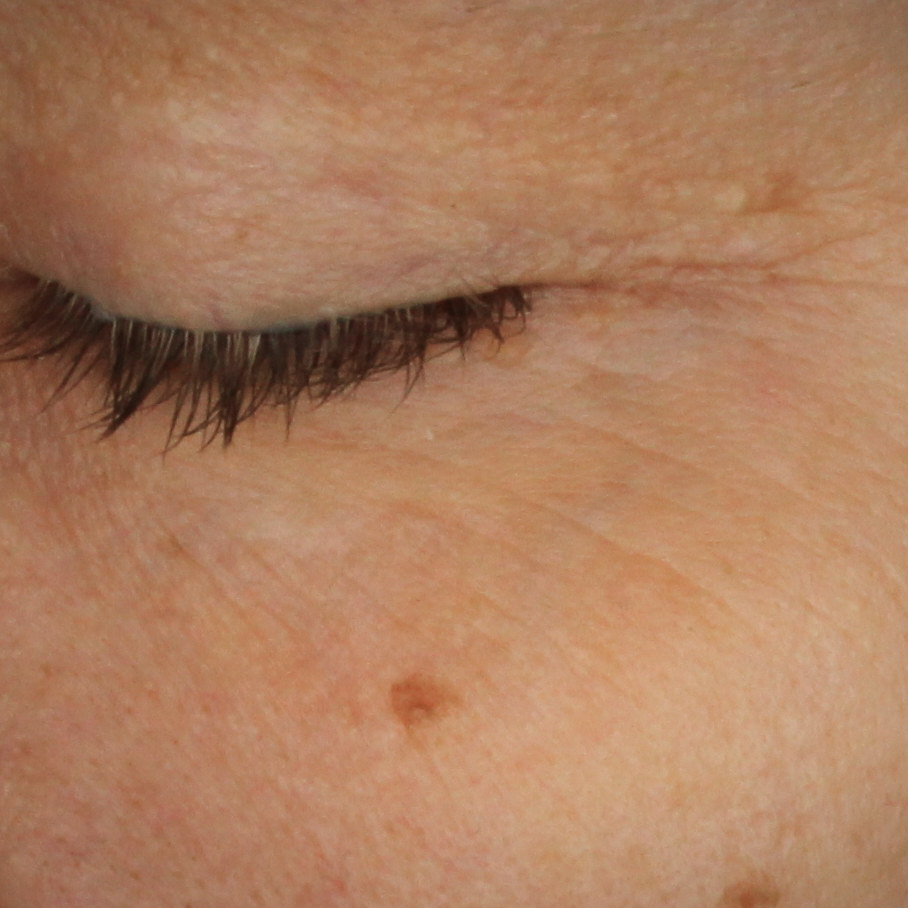 Retinol Alternative Eye Serum, after 8 weeks