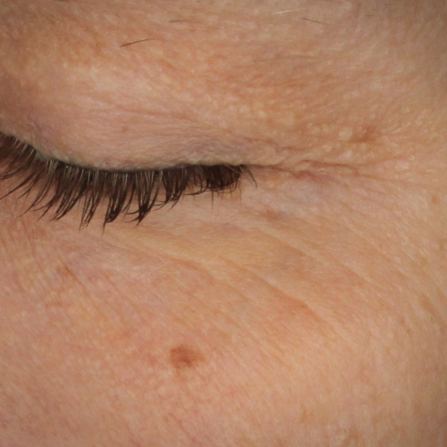 Retinol Alternative Eye Serum, before