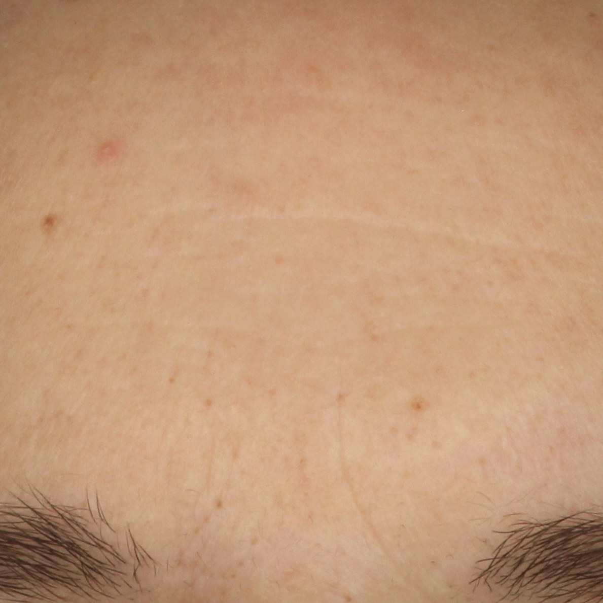 Retinol Alternative Serum, after 8 weeks