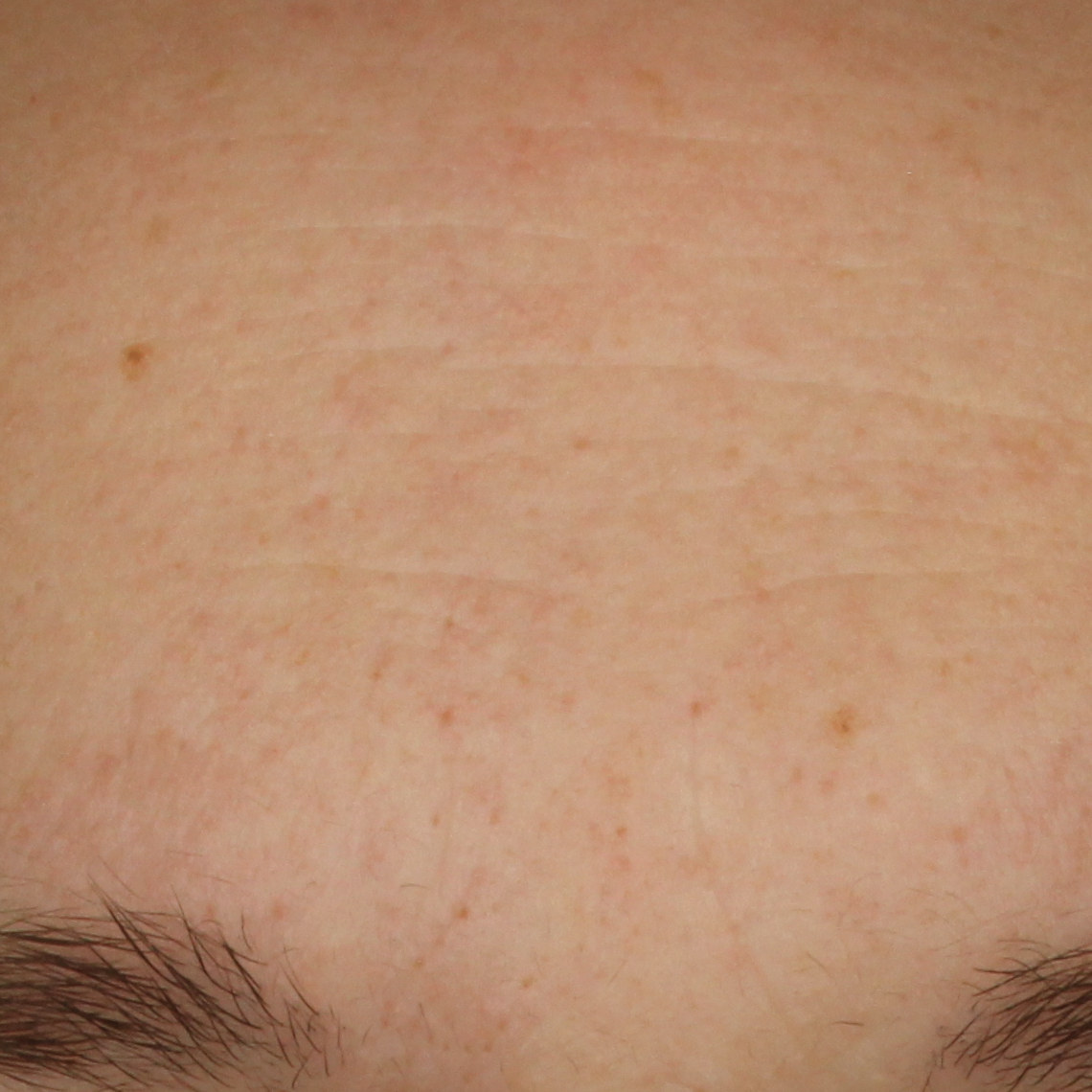 Retinol Alternative Serum, before