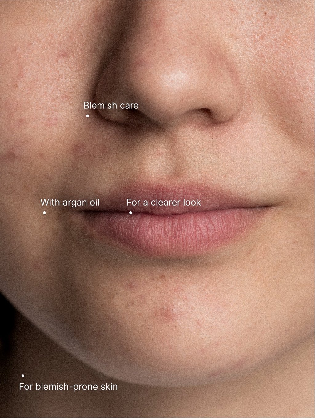 Acne Care Moisturiser with its key benefits