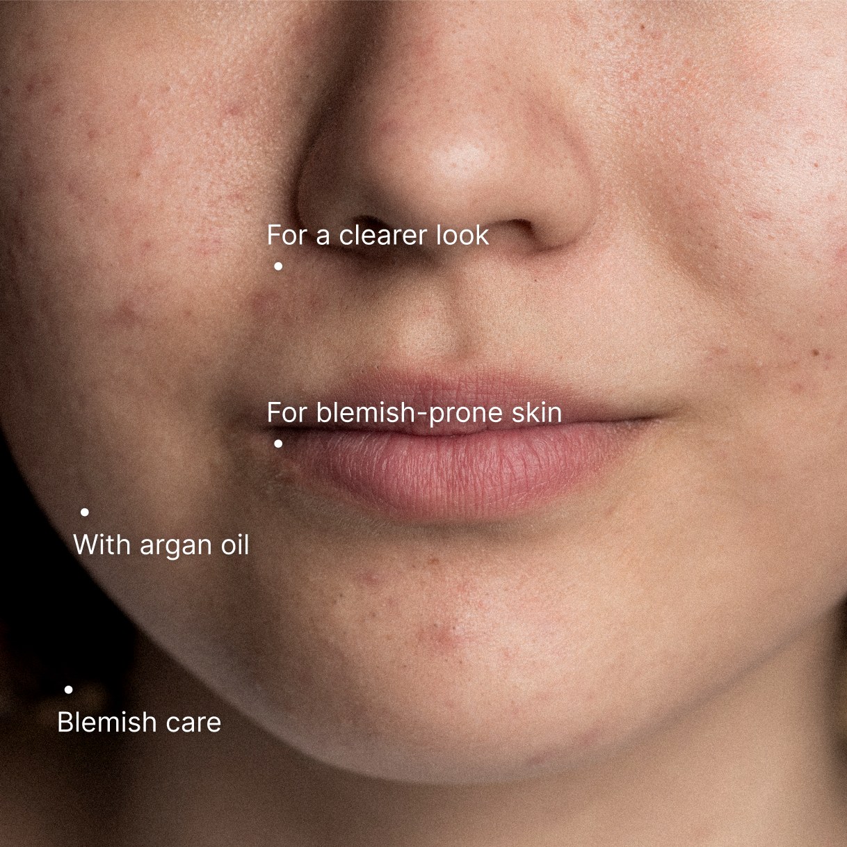 Acne Care Moisturiser